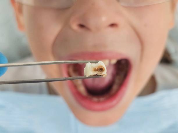 Best Emergency Dental Filling Replacement  in Mp Pendleton South, CA